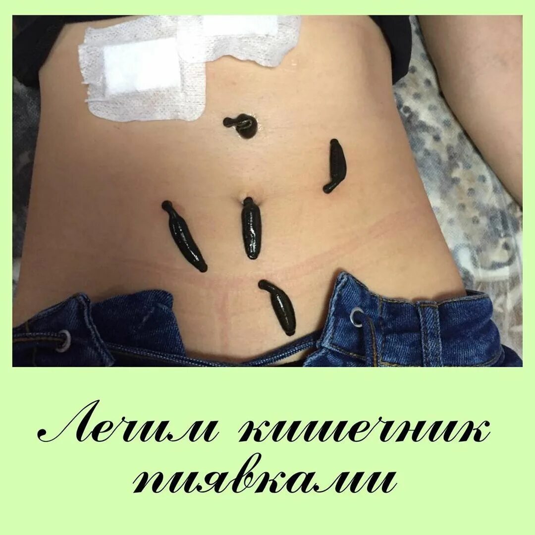 Точки для пиявок для похудения. Пиявки для похудения куда ставить. Гирудотерапия точки постановки пиявок схемы. Гирудотерапия постановка. Схема точек постановки пиявок при гипертонии.