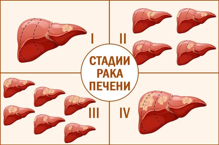 Раковая опухоль печени. Стадии онкологии печени. Первая стадия печени