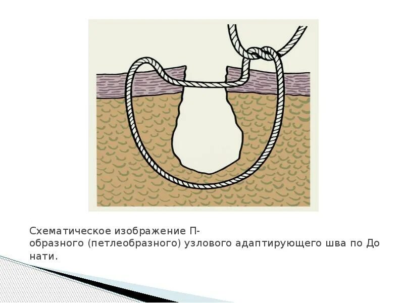 Шов по донати и альговеру. Шов по донати техника. Шов донати в модификации альговера. Шов по альговеру техника. Вертикальный матрацный шов донати.