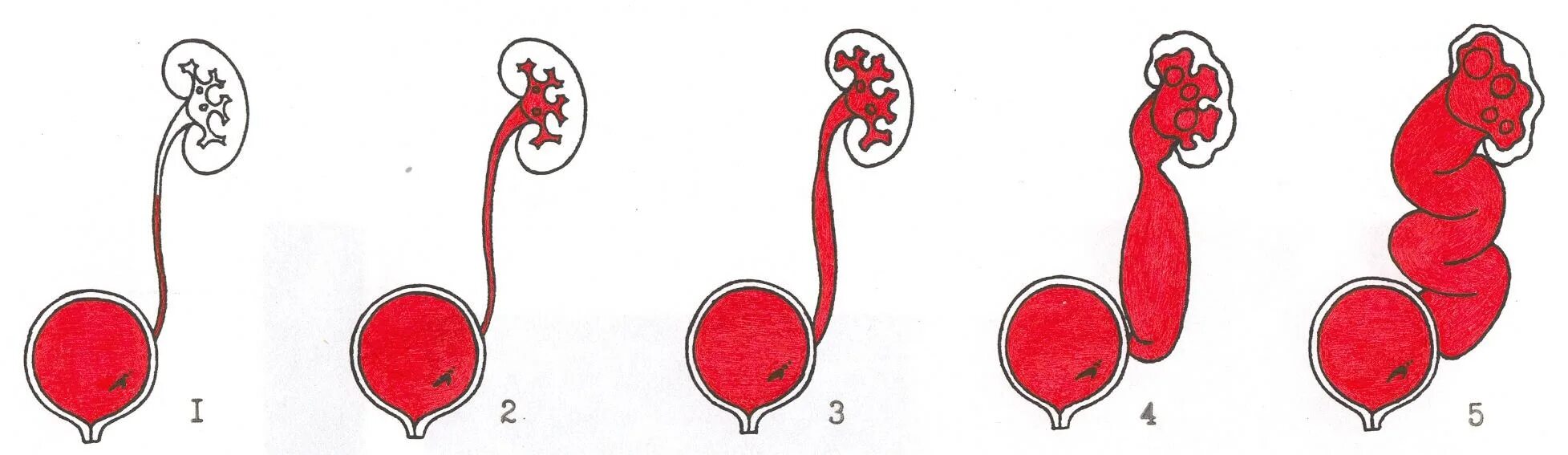 Пузырно-мочеточниковый рефлюкс классификация. Классификация пузырно-мочеточникового рефлюкса. Пузырно-мочеточниковый рефлюкс 5 стадий. Пузырно-мочеточниковый рефлюкс классификация у детей. Рефлюкс мочеточника