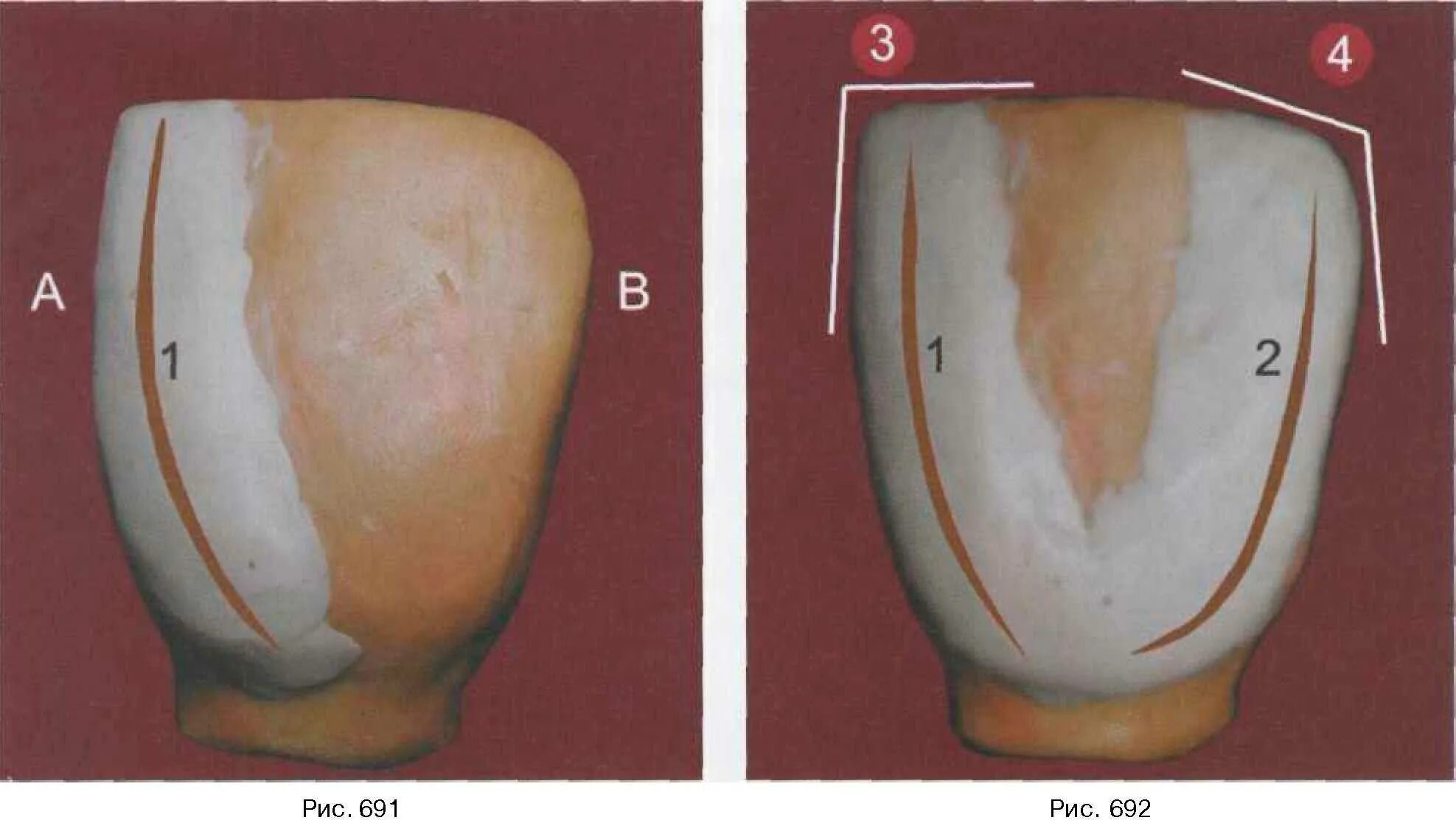 Медиальный резец верхней челюсти анатомия моделирование. Латеральный резец верхней челюсти анатомия. Верхний центральный резец моделировка. Поверхности латерального резца верхней челюсти. 2 верхний резец.