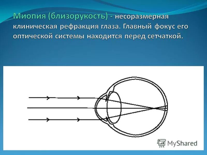 Что такое гиперметропия слабой степени