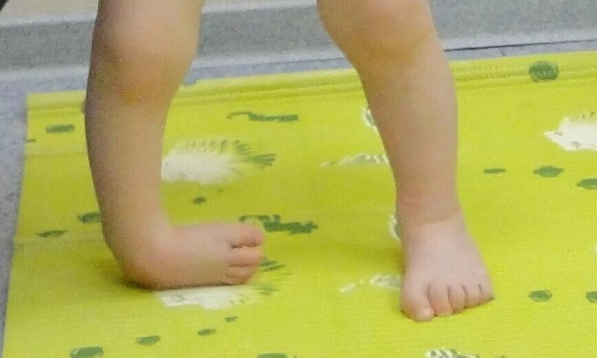 артрогрипотическая косолапость. врождённая деформация стоп косолапость. косолапость у ребенка стопы. врожденная косолапость травматология. косолапость метод понсети.