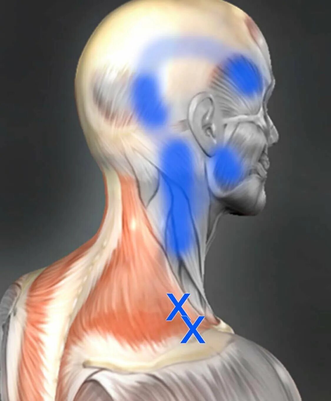 Напряжение в шее и затылке. Триггеры шеи. Триггеры трапециевидной мышцы. Мышцы затылка.