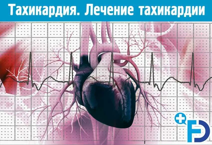 Тахикардию можно вылечить