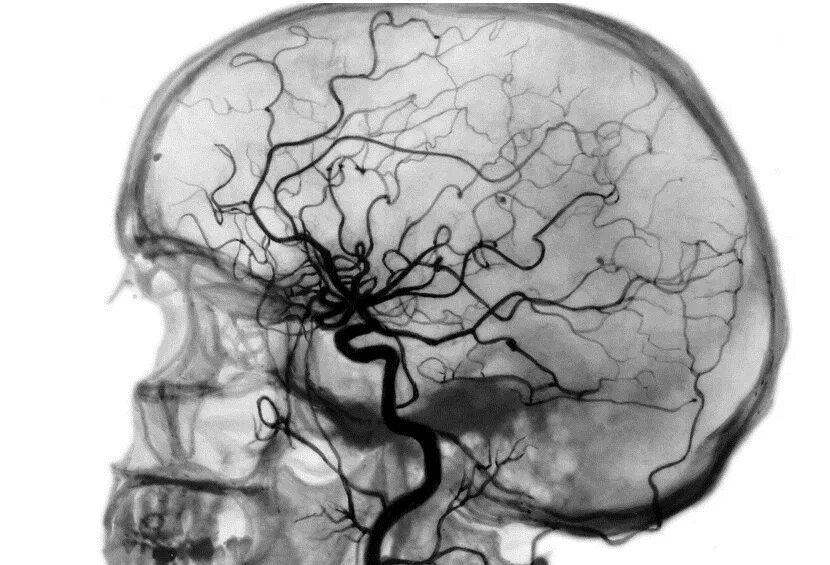 Церебральная ангиодистония что это. Ангиограмма сосудов головного мозга. Каротидная ангиография головного мозга. Мрт ангиография сосудов головного мозга. Компьютерно-томографическая ангиография сосудов головного мозга.