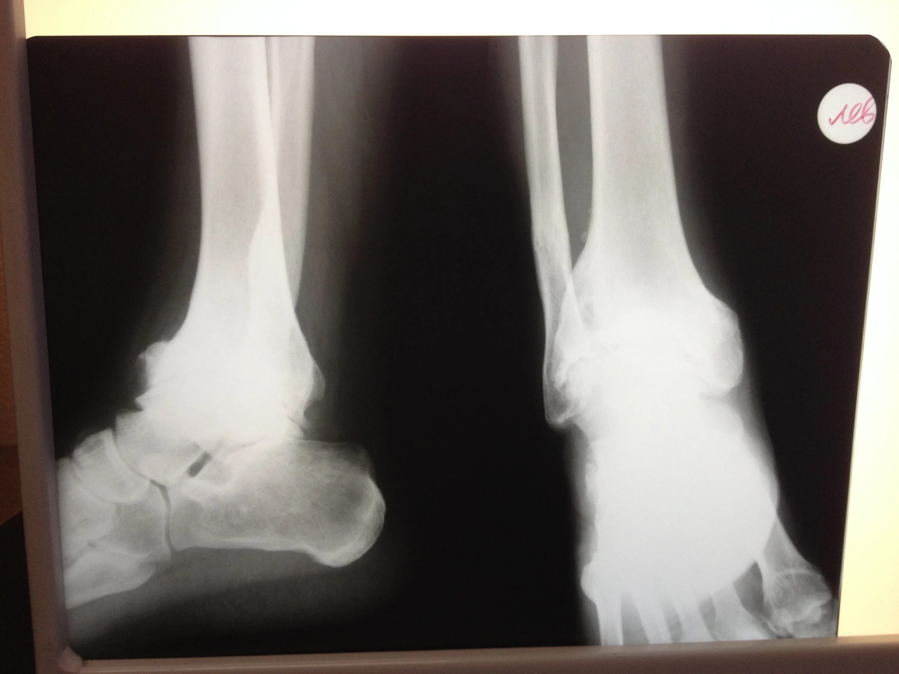 отзывы после артродеза голеностопного сустава