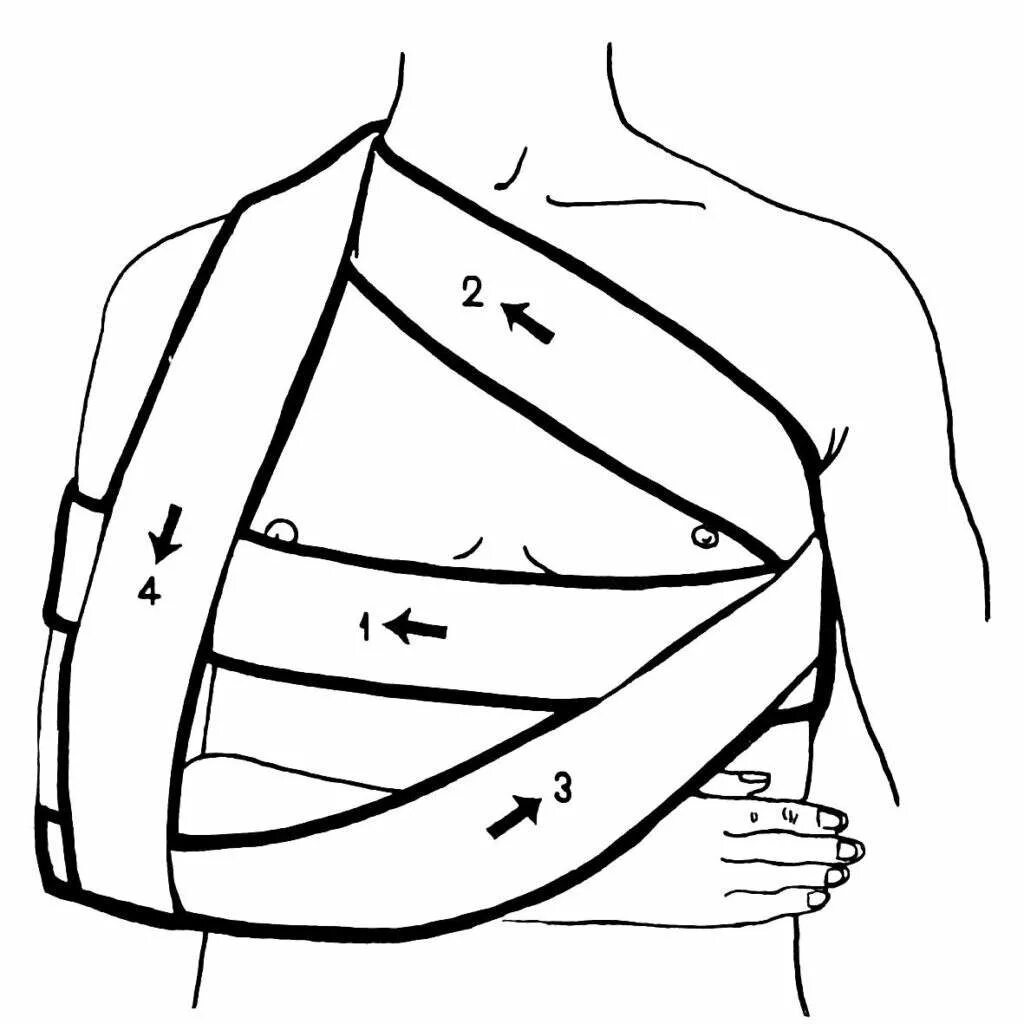Повязка на руку схема. Наложение повязки Дезо. Дезо повязка бинтом алгоритм. Наложение повязки Дезо алгоритм. Повязка Дезо техника наложения.