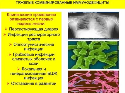 Инфекция иммунодефицита