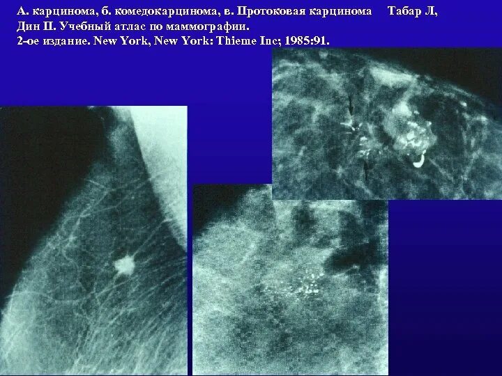 Инфильтрированная опухоль. Инфильтративная карцинома. Протоковая карцинома молочной железы. Инфильтрирующая протоковая карцинома. Протоковая карцинома молочной железы на УЗИ.