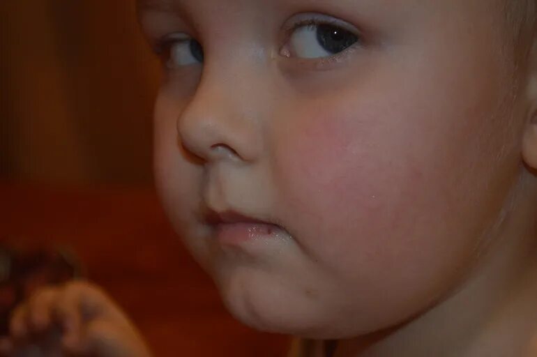 у ребенка красные щеки причины 2 года