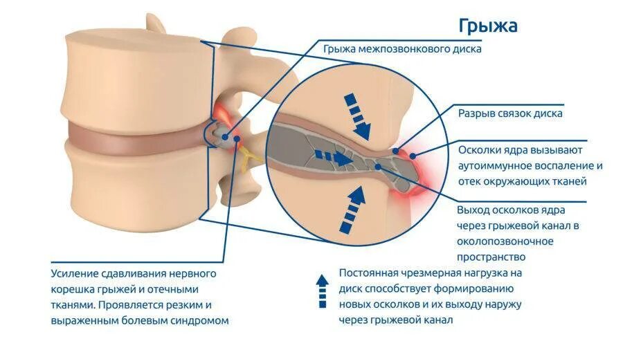 Грыжа диска. Межпозвоночная грыжа. Нагрузка на межпозвоночный диск. Грыжа спинного диска.