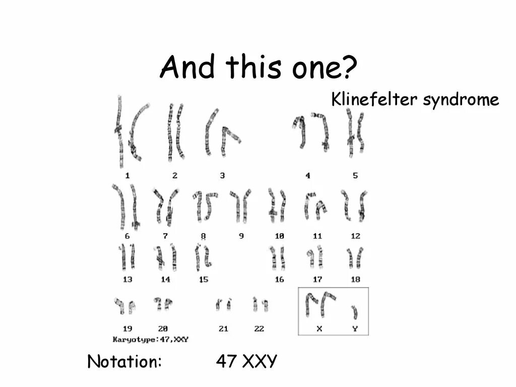 Xxy синдром Клайнфельтера кариотип 47. Klinefelter Syndrome karyotype. Синдром Клайнфельтера 47 xxy.