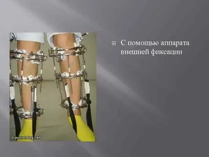 Внешняя фиксация