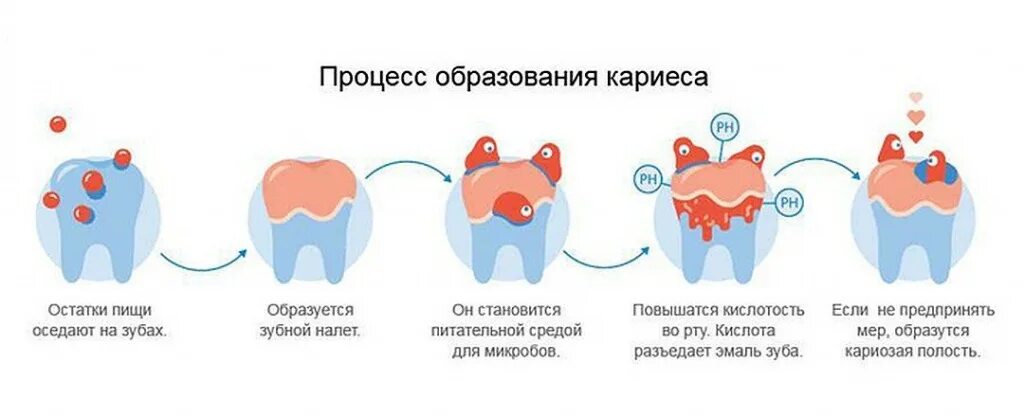 Этапы возникновения кариеса. Этапы формирования кариеса. Стадии развития кариеса зубов у детей.