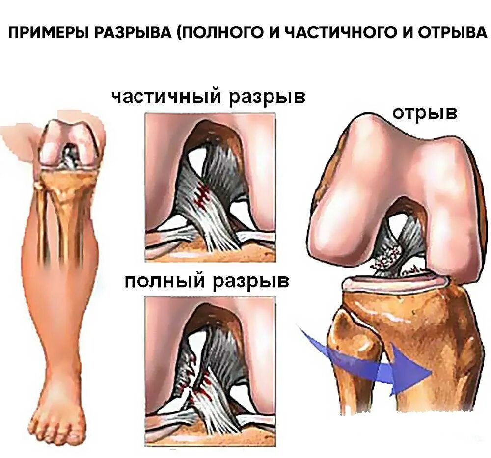 Что значит связки. Частичное повреждение передняя крестообразная связка. Крестовые связки коленный сустав. Разрыв связок ПКС коленного сустава. Повреждения передней крестообразной связки 2 степени.
