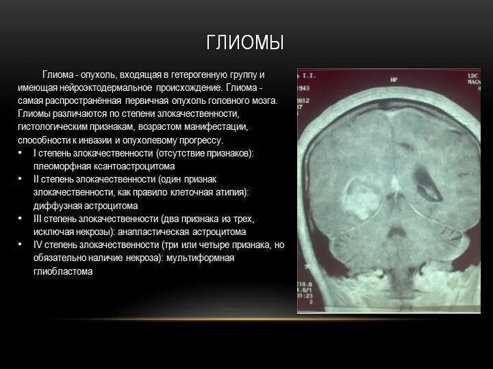 Глиома степени. Глиома ствола головного мозга симптомы. Опухоль головного мозга глиобластома 4. Понятие злокачественности опухоли головного мозга. Объемное образование головного мозга.