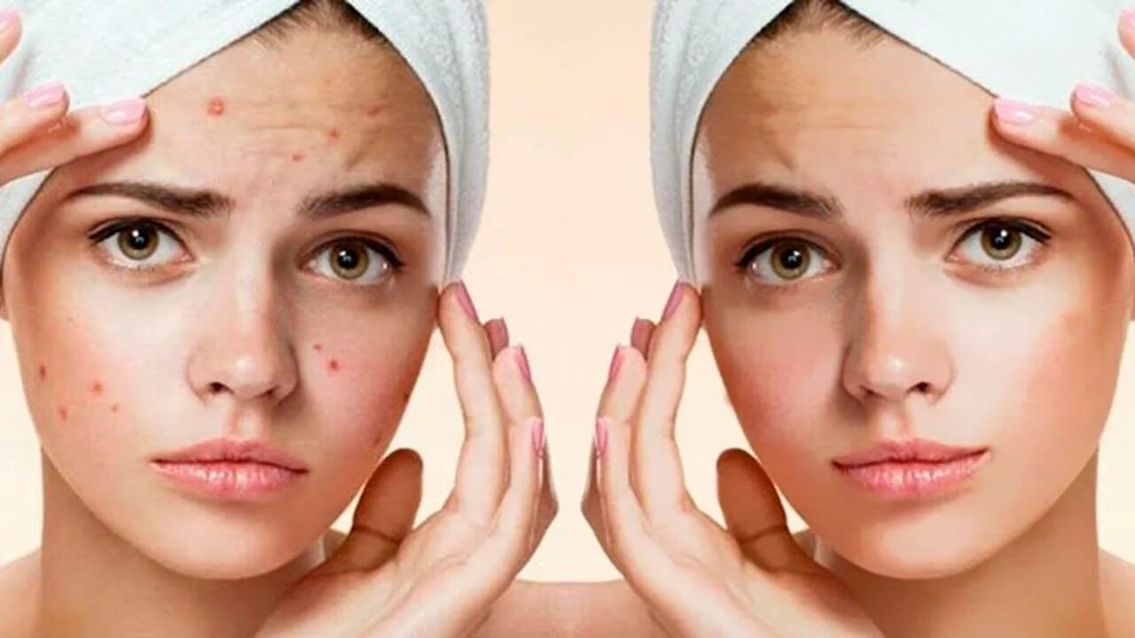 Фотолечение акне/постакне. Как избавиться от акне подростков. Как избавиться от акне подростков. Узелково-кистозные акне. Гиперпигментация акне.