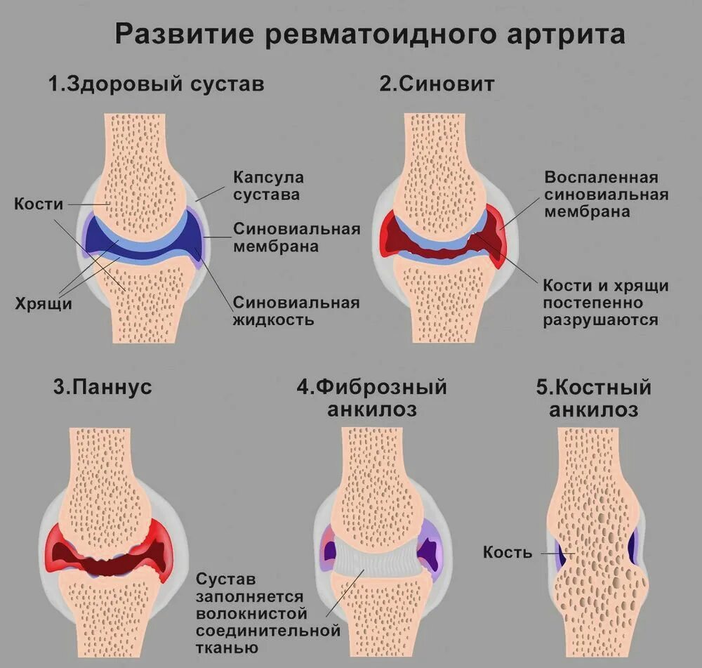 Артрит что это. Ревматоидный артрит синовиальная жидкость. Ревматический полиартрит и ревматоидный артрит. Суставная форма ревматоидного артрита. Ревматоидный артрит изменения в суставах.