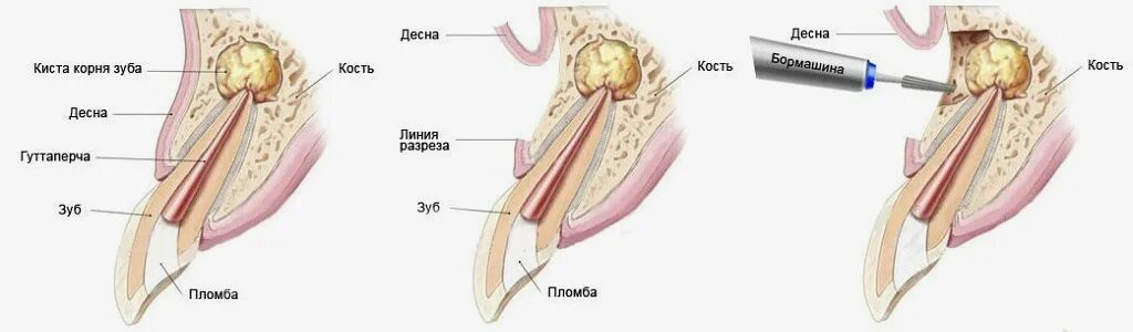 Операция резекции верхушки корня зуба. Резекция верхушки корня схема. Резекция верхушки корня Нижнего 6 зуба. Резекция верхушки корня этапы. Цистоэктомия