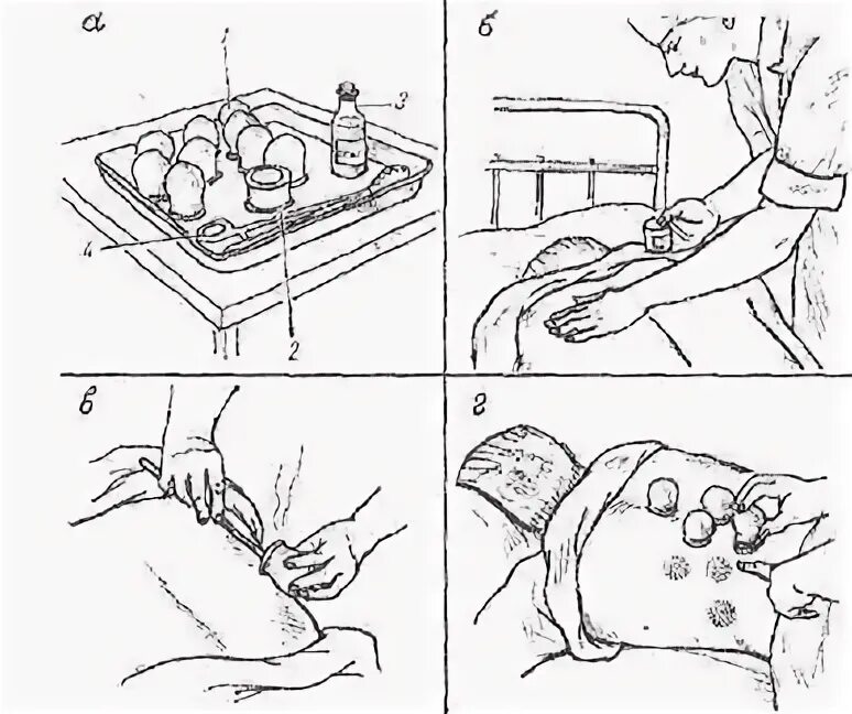 Постановка вакуумных банок алгоритм. Вакуумные банки схема постановки. Схема установки массажный ваакумных банок. Схема постановки вакуумных банок. Можно ставить банки при кашле взрослому