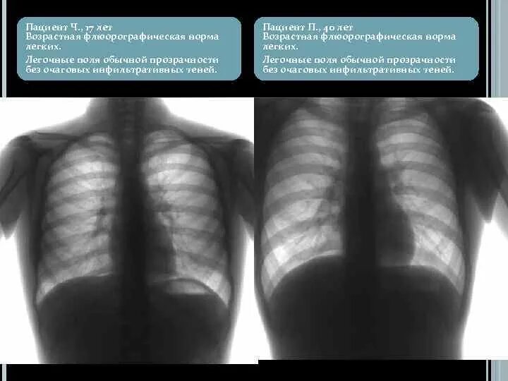 Лёгочные поля без очаговых и инфильтративных теней. Легочные поля без очаговых и инфильтративных изменений. Лёгкие без очаговых и инфильтративных изменений. В легких без очаговых и инфильтративных теней что это такое. Без очаговых и инфильтративных изменений