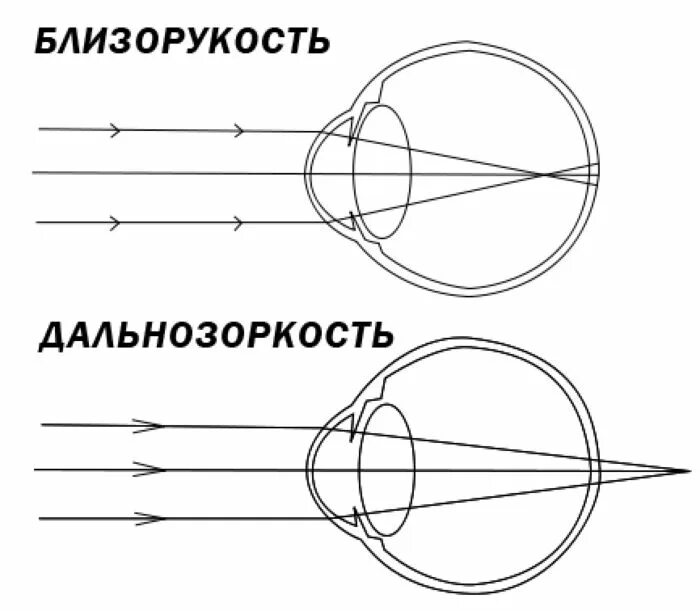 Коррекция зрения с помощью линз. Близорукость и дальнозоркость схема физика. Схема хода световых лучей при близорукости. Гиперметропия схема глаза. Близорукость и дальнозоркость схема глаза.