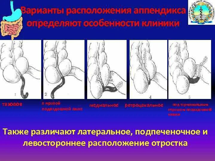 Варианты расположения червеобразного отростка Аппендикса ретроцекальный