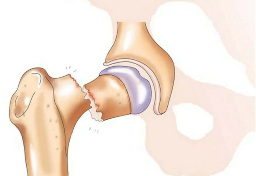 Тазобедренный сустав перелом шейки бедра. Открытый перелом шейки бедра. Вколоченный перелом тазобедренного сустава. Субтотальный перелом шейки бедра. Перелом шейки бедра тазобедренного сустава