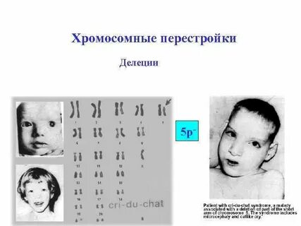 Синдром делеции