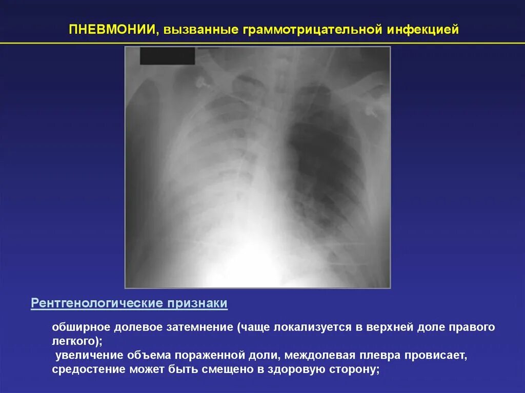 Затемнение верхней доли легкого. Обширное затемнение легкого. Затемнение в легких при пневмонии. Рентгенологические признаки долевой пневмонии.