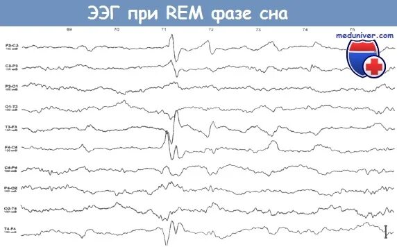 Rem фаза сна ЭЭГ. Rem сон на ЭЭГ. Rem стадия сна. Доброкачественный миоклонус сна на ЭЭГ.