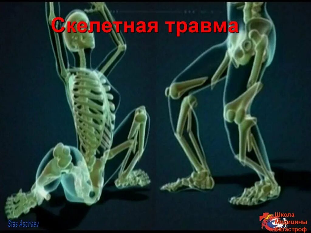 Понятие Скелетная травма.