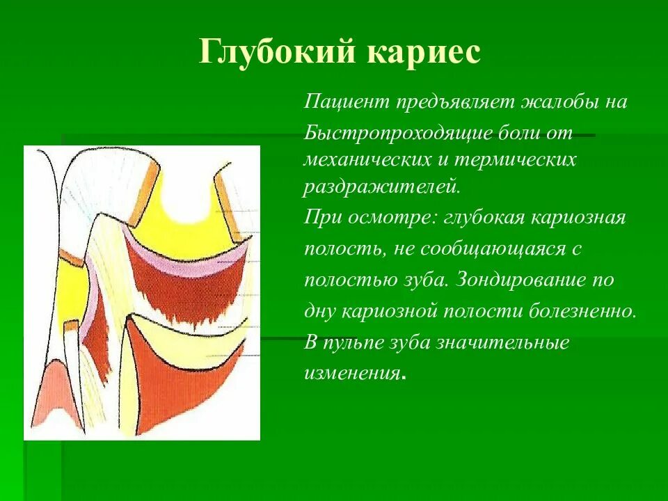 Кариозная полость сообщается с полостью зуба