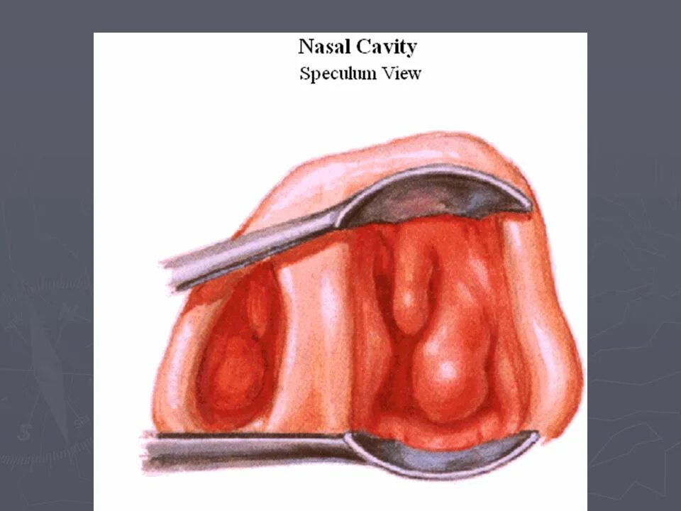 Аденоиды носовые у детей. Симптомы аденоидита у детей. Симптомы при аденоидах. Препараты от аденоидов. Анализ крови при аденоидите.