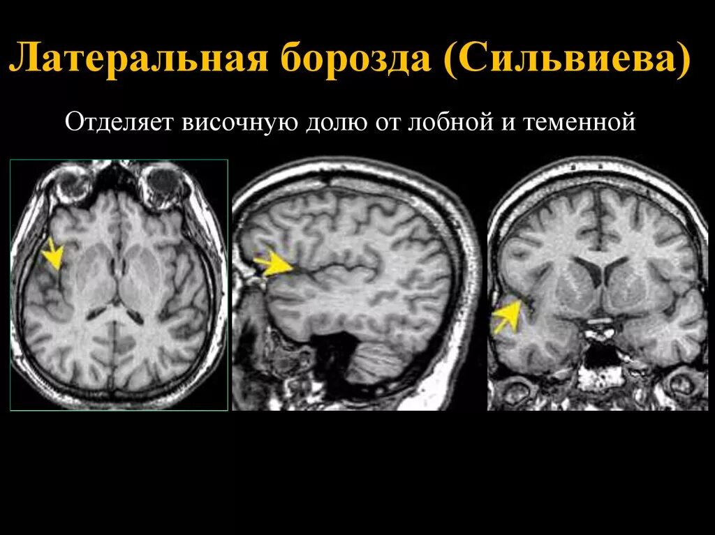 Сильвиева щель мрт. Анатомия плода сильвиева борозда. Сильвиева щель в головном мозге. Сильвиева щель анатомия.