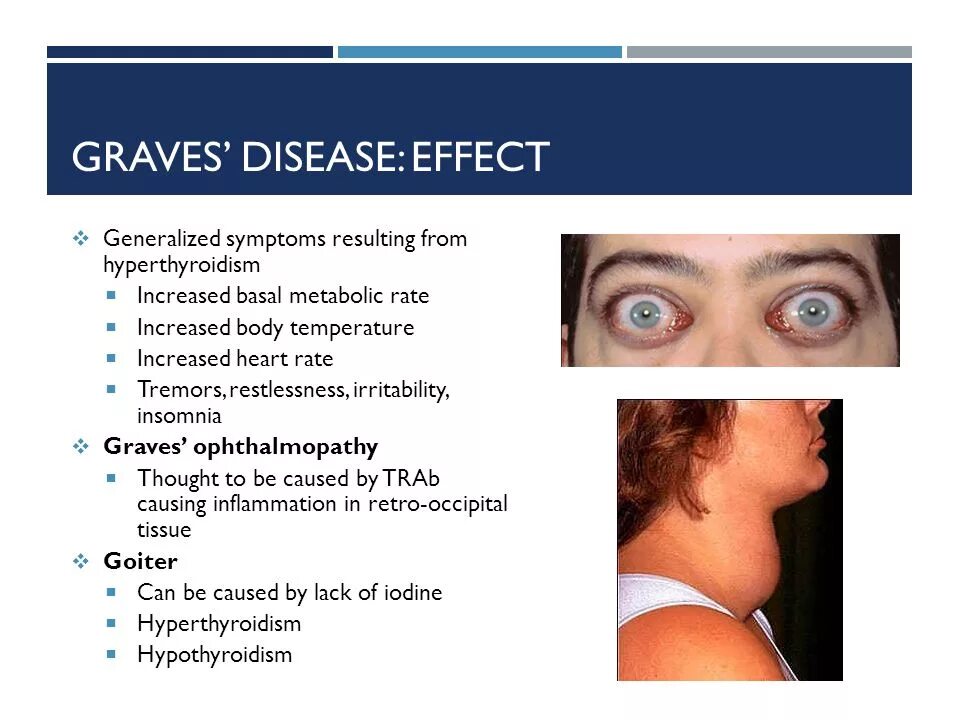 Диффузный токсический зоб гипертиреоз. Диффузный токсический зоб экзофтальм. Диффузный токсический зоб (болезнь Грейвса, базедова болезнь). Диффузный токсический зоб клинические рекомендации. Диффузный токсический зоб клинические