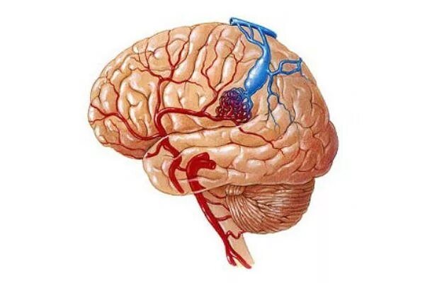 Brain 81. Церебральная артериовенозная мальформация. Мальформация сосудов головного мозга. Сосудистая мальформация головного мозга. Артериовенозная мальформация артерии.