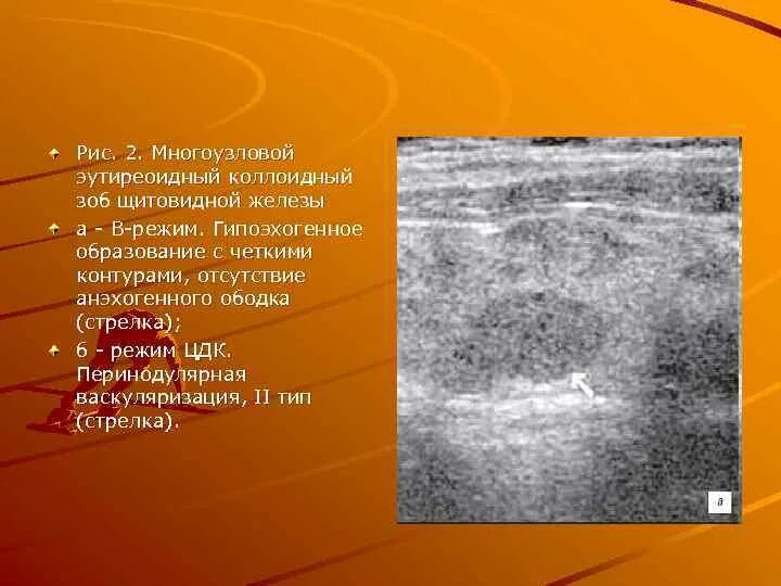 Васкуляризация усилена. Гипоэхогенный контур узла щитовидной железы. Гипоэхогенный узел щитовидной железы на УЗИ. Гипоэхогенное образование щитовидной. Типы васкуляризации щитовидной железы.