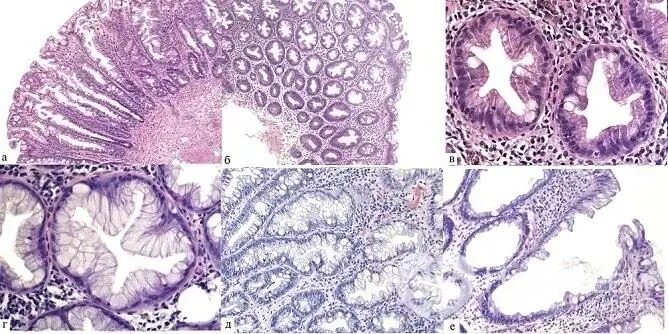 Микровезикулярный полип толстой кишки. Полип толстой кишки гистология. Аденоматозный полип толстой кишки гистология. Гиперпластический полип кишки гистология. Ворсинчатый полип гистология.