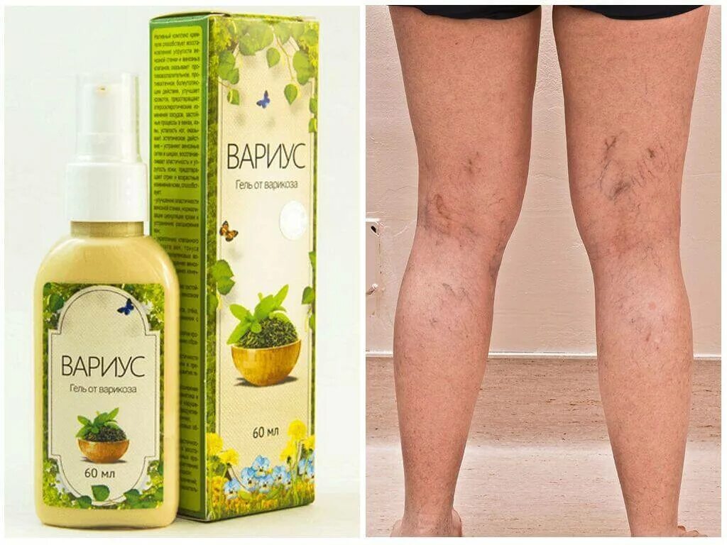 от варикозного расширения вен ног. степени варикозного расширения вен нижних конеч. варикозное расширение вен. варикозное расширение вен на ногах. лечение варикоза вен на ногах.
