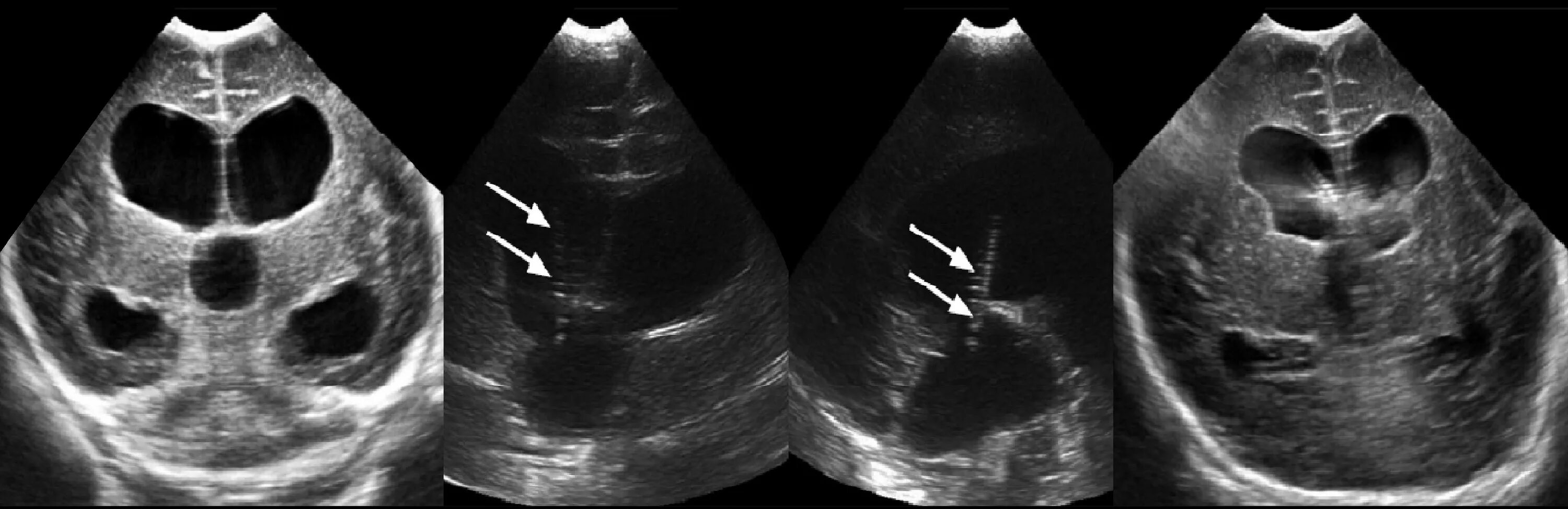 Гидроцефалия нейросонография. НСГ вентрикуломегалия. УЗИ головного мозга нейросонография.