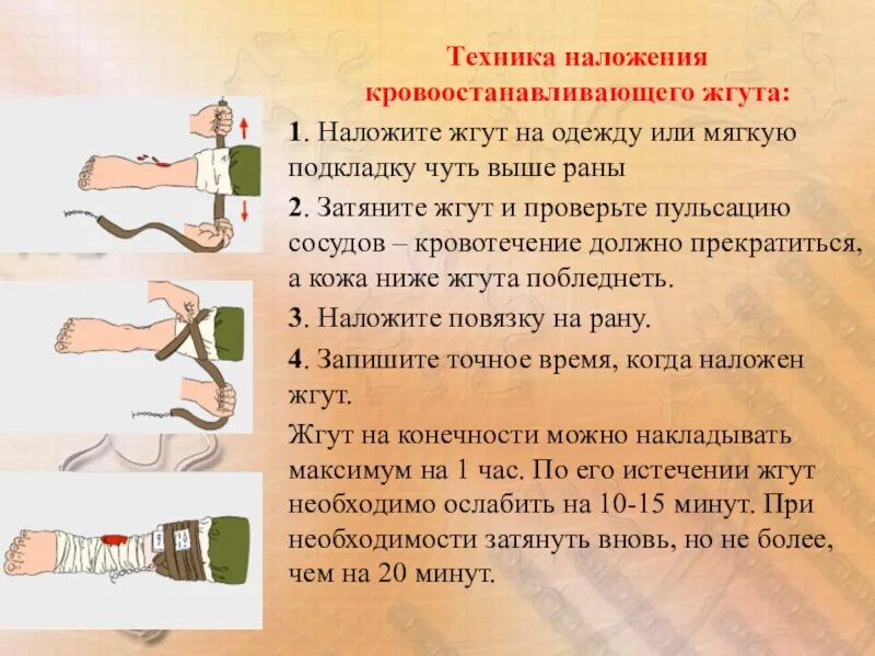 Какой жгут лучше. Порядок наложения кровоостанавливающего жгута на конечность. техника наложения кровоостанавливающего жгута. техника наложения жгута при артериальном кровотечении. методика наложения кровоостанавливающего жгута.