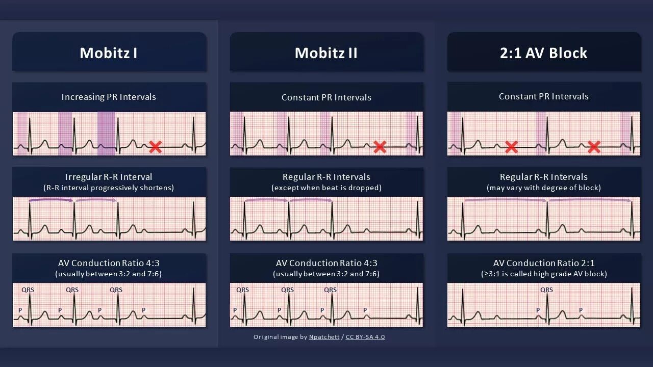 3rd degree av Block ECG. Av Block ECG 2 degree. Av Block ECG 1 degree. Av Blocks 3 degree ECG. Av блок