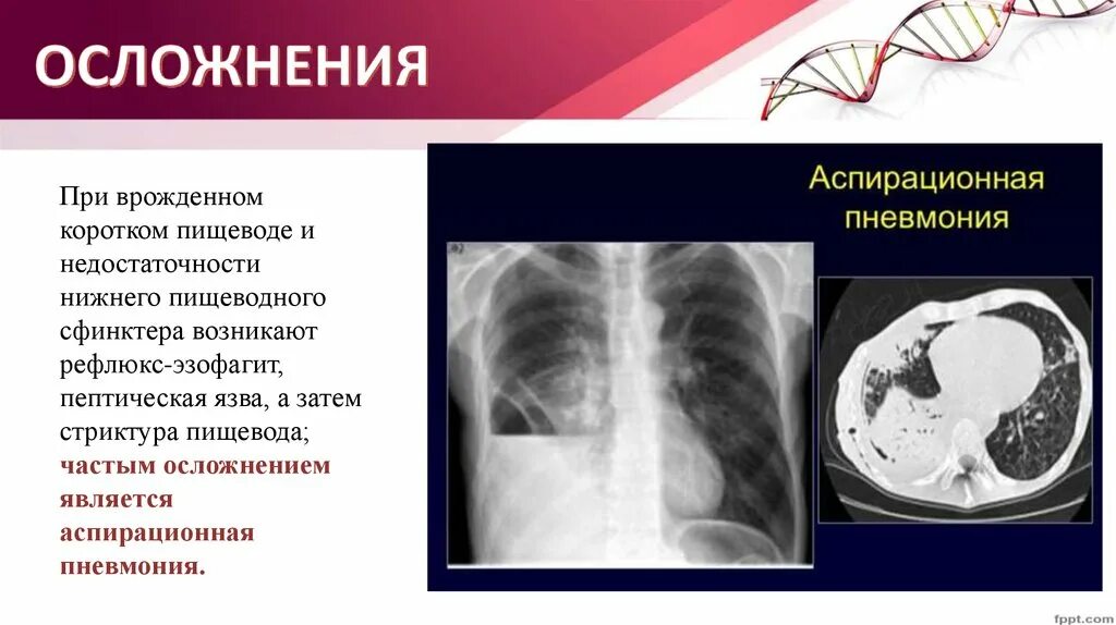 Короткий пищевод. Врожденный короткий пищевод. Врожденный короткий пищевод рентген. Врождённый короткий пищевод осложнение. Короткий пищевод рентген.