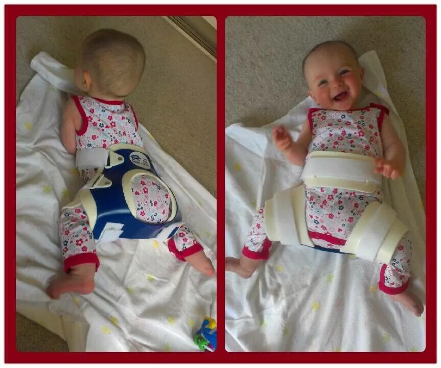 Дисплазия тазобедренного сустава у младенца. Дисплазия суставов 3 месяца. У новорожденных дисплазия тазобедренного сустава новорожденных. Массаж при дисплазии тазобедренных суставов у грудничков. Дисплазия суставов 3 месяца.