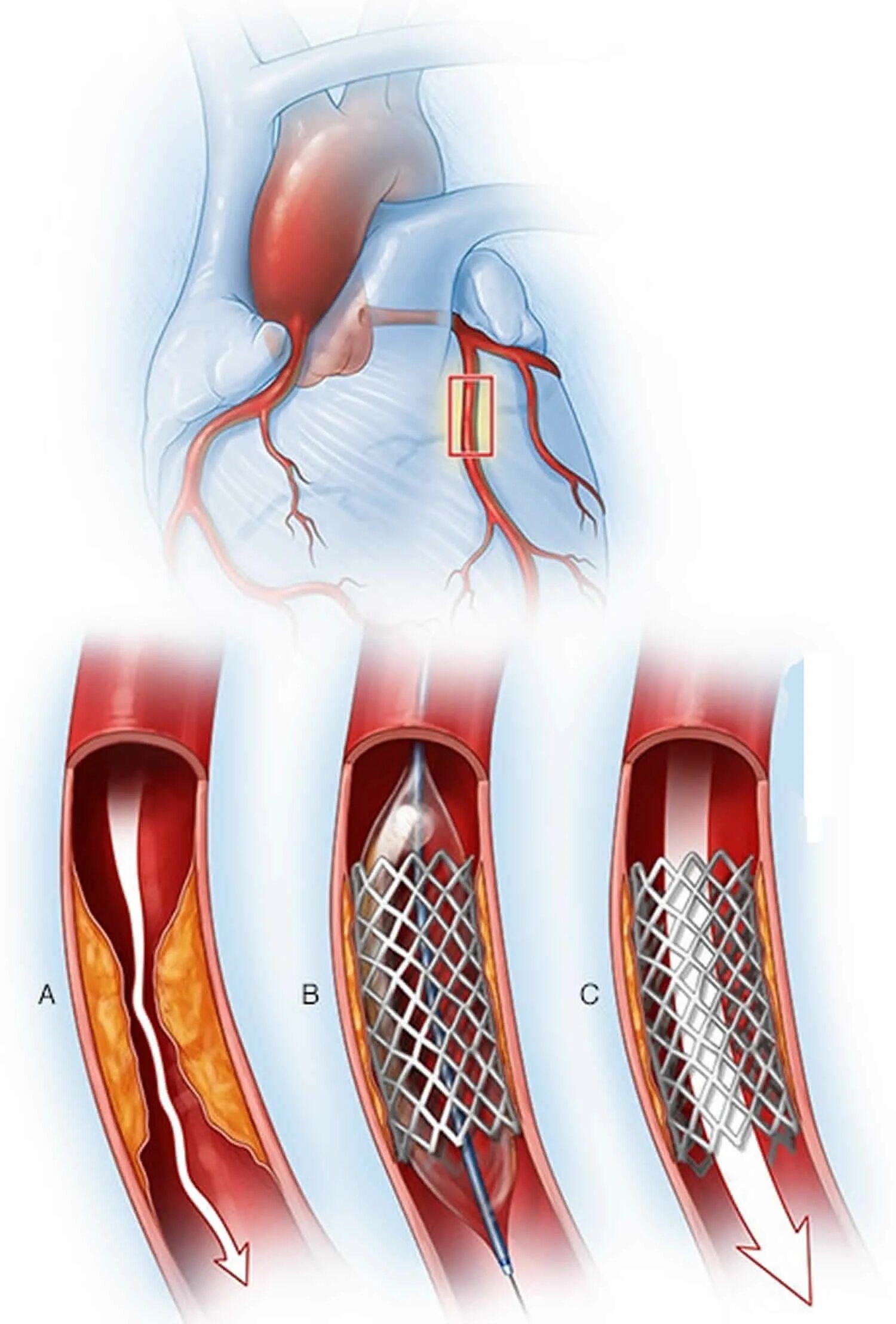 Стентирование коронарных артерий. Коронарное стентирование сосудов сердца. Шунтирование сосудов сердца стент. Операция шунтирование ног