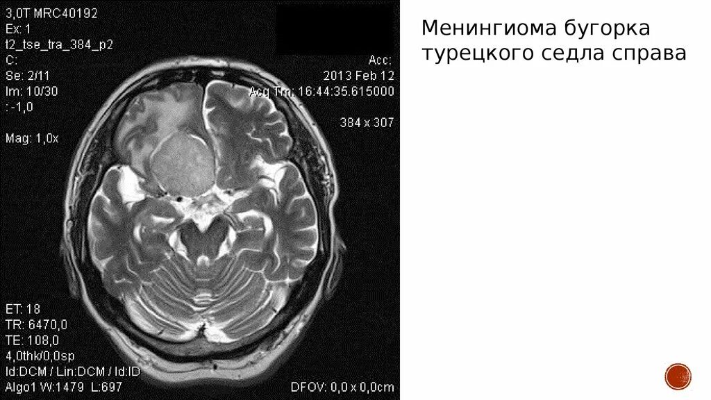 Менингиомы головного мозга мкб