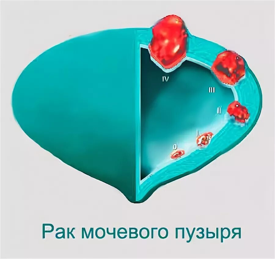 Рак мочевого пузыря лечение в израиле. Уротелиальная папиллома мочевого пузыря. уротелиальная карцинома мочевого пузыря.