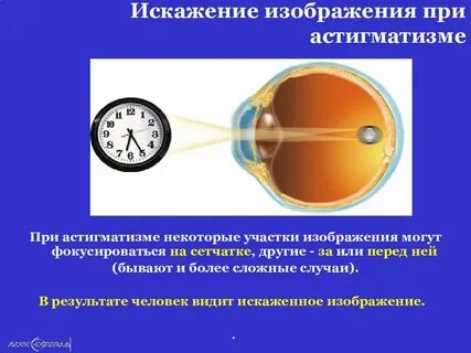 Астигматизм минус